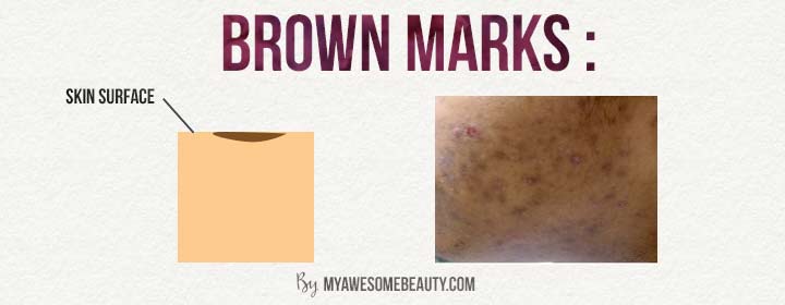 Those brown spots left on the skin after an acne breakout is what’s 