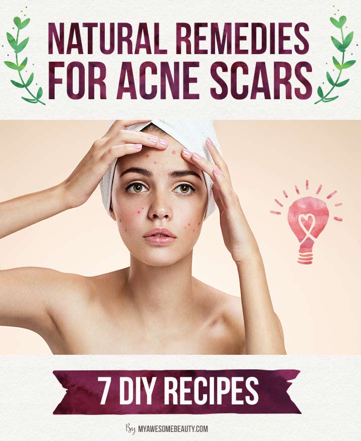 How To get Rid of Acne Scars Fast | The 20 Best Treatments ...