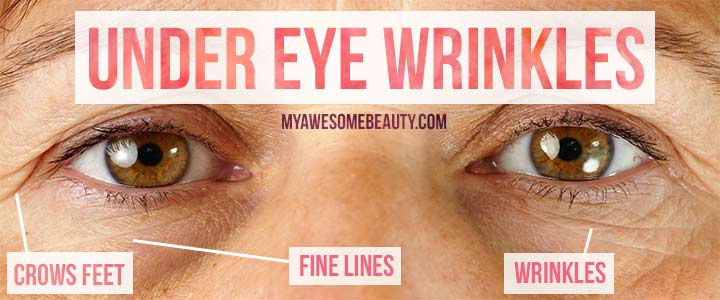 under eye wrinkles