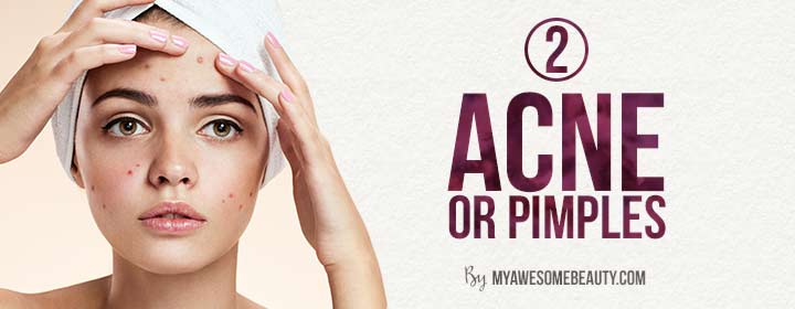 acne or pimples