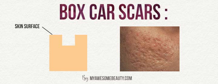 box car scars