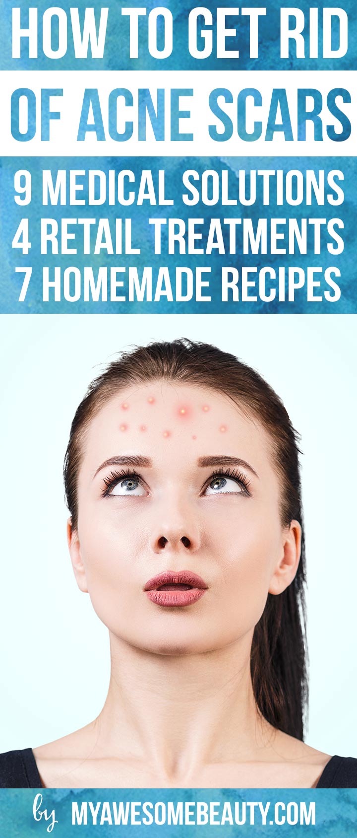 how to get rid of acne scars fast | the 20 best treatments and tips