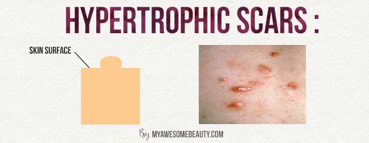 hypertrophic scars