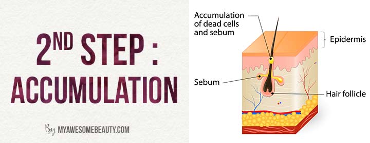 second step of acne scar formation