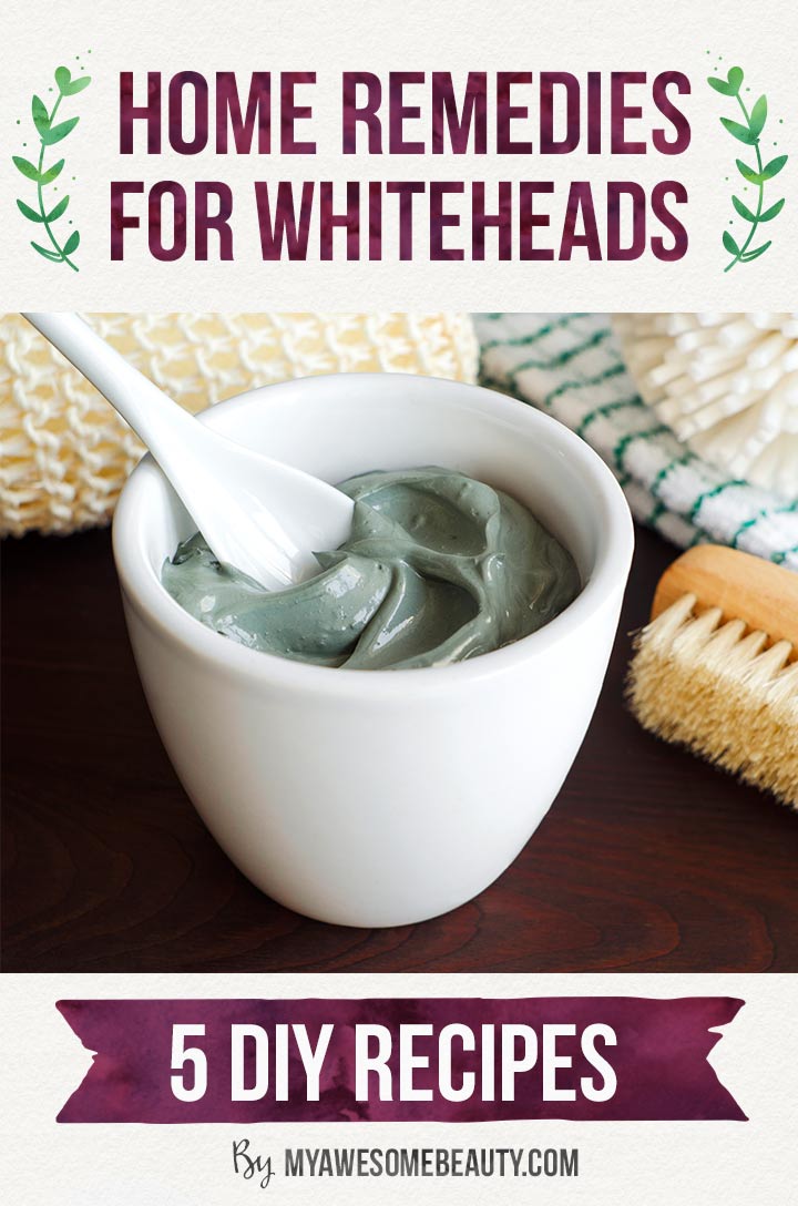 Natural home remedies for whiteheads