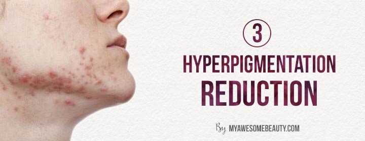 reason 3 hyperpigmentation reduction