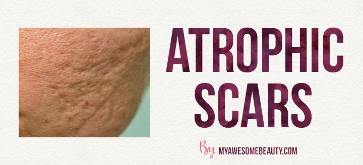 atrophic scar