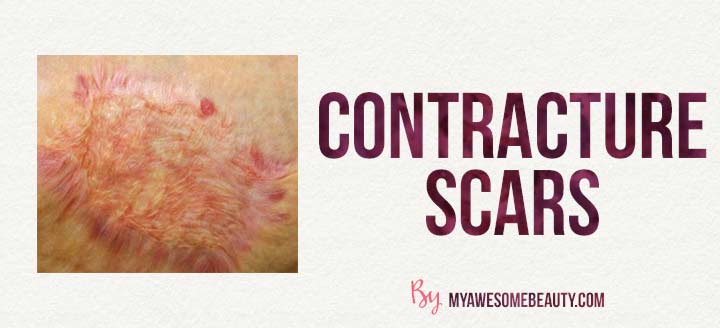 contracture scar