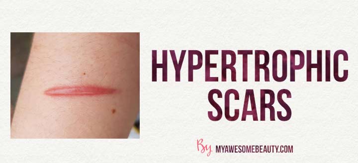 example of hypertrophic scars