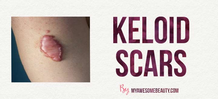 example of keloid scars