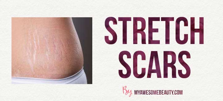 stretch scar